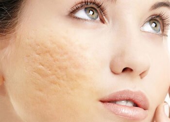 Acne scars (boxcar scars): Treatment of scarring 10 Acne scars