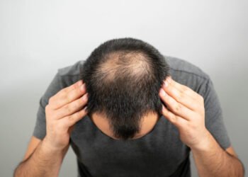 How Can You Prevent Male Pattern Baldness? 41 Male Pattern Baldness
