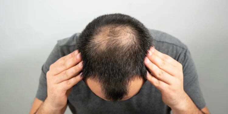 How Can You Prevent Male Pattern Baldness? 1 Male Pattern Baldness