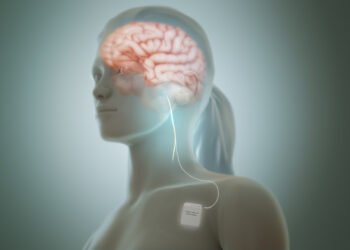 Deep Brain Stimulation - DBS 2 deep brain stimulation