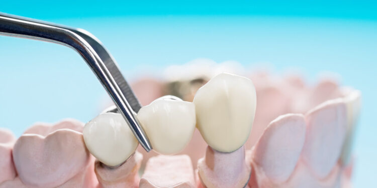 Crown vs Bridge: Whats the Difference? 2 What Is a Dental Crown