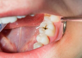 Feelings of a Cavity: 6 Sensations to Watch For 8 Feelings of a Cavity