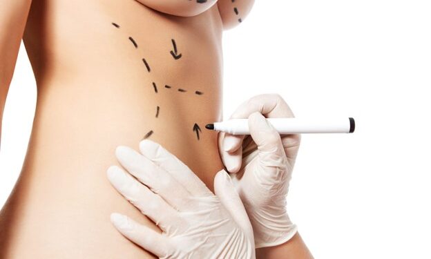 Tummy Tuck