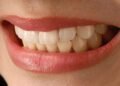 Exploring the Different Types of Veneers 18 Different Types of Veneers