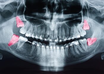 An Essential Guide on Wisdom Tooth Infection Symptoms 2 Wisdom Tooth Infection