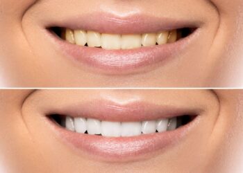 Unleash Your Confidence with a Smile Makeover