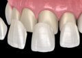 Porcelain Veneers in Dental