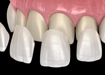 Porcelain Veneers in Dental